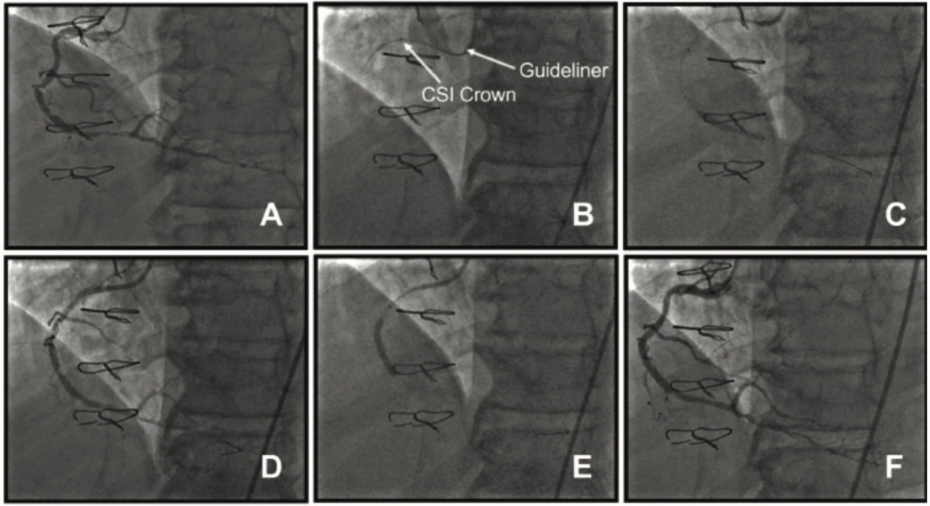 El Hajj Orbital Atherectomy Figure 2
