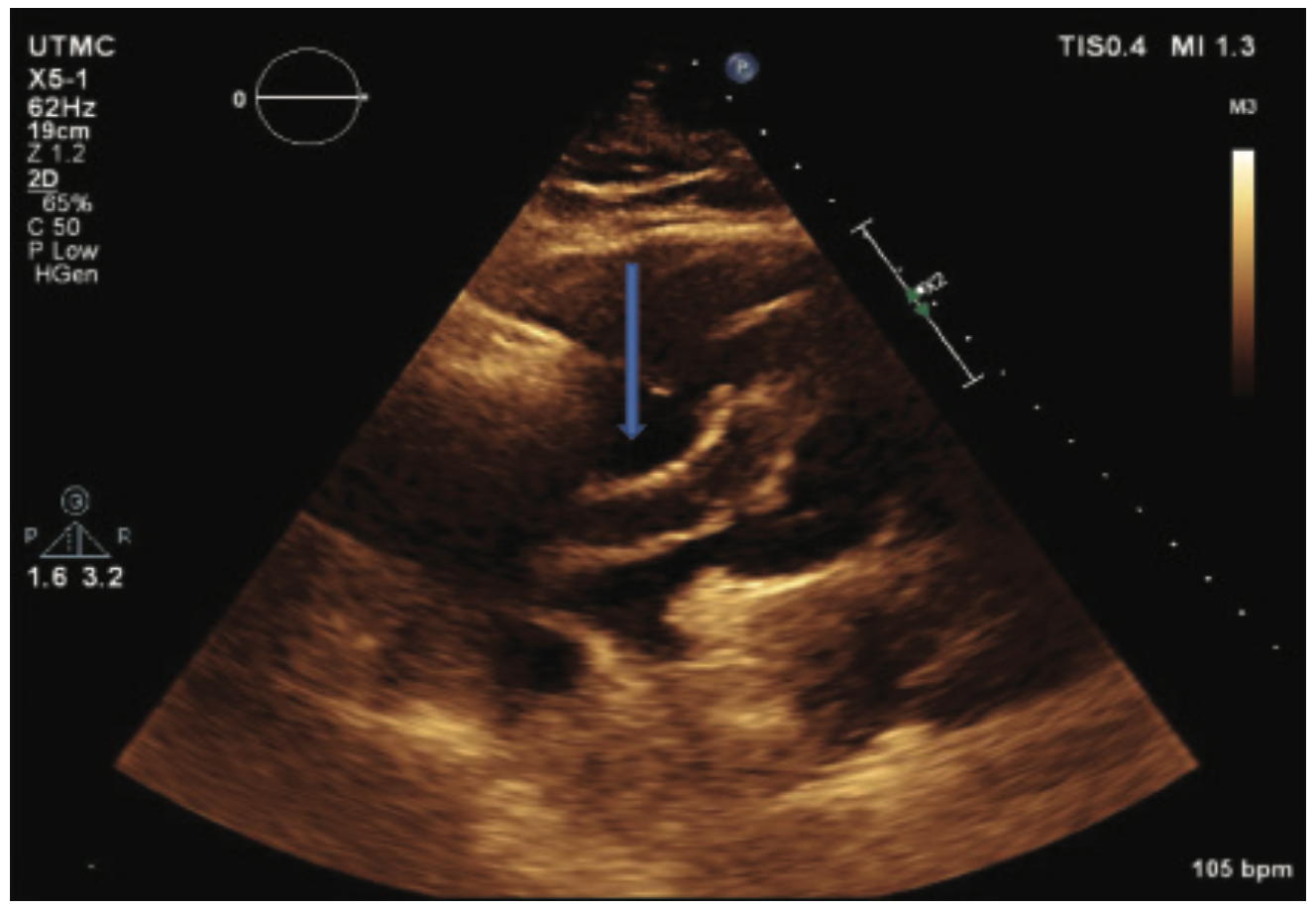 Elzanaty Clot Figure 2