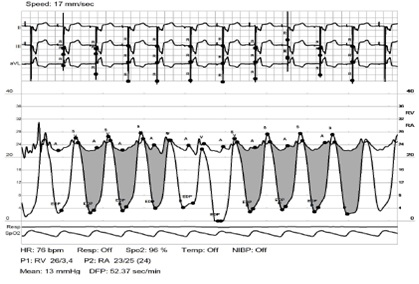 Figure 5. Invasive hemodynamics (case 2).