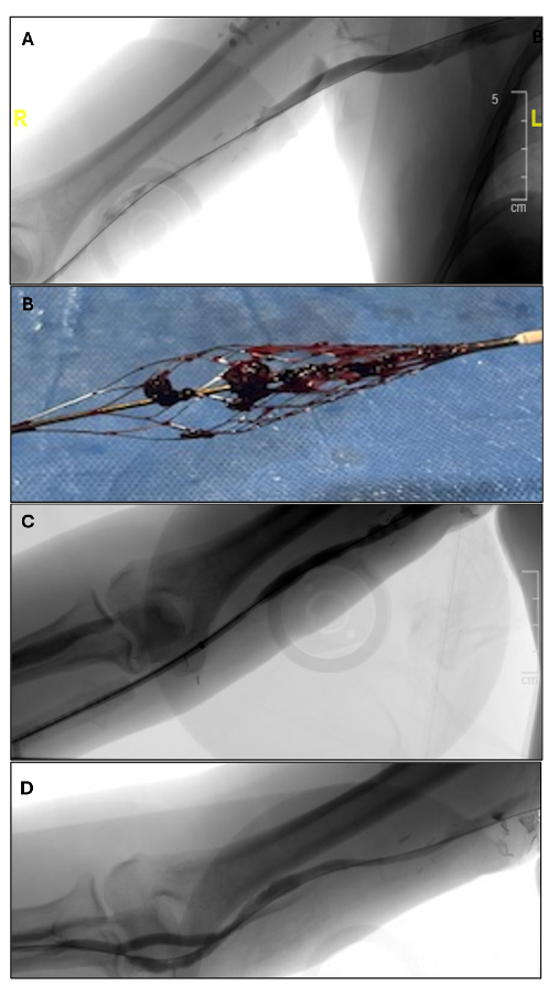 Figure 3, Case 1. A) Venography showing cephalic vein stenosis with thrombosis. B) Photograph of the InThrill coring element containing thrombotic material. C) Venography showing cephalic vein following thrombectomy with the InThrill device showing full outflow patency. D) Completion venography of the anastomosis following angioplasty, showing strong flow.