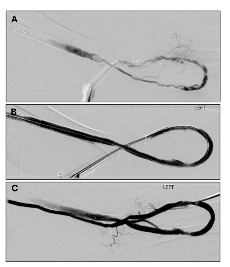 Figure 4, Case 2. A) Venography showing extensive thrombus throughout the loop graft. B) Venography following thrombectomy with the InThrill device, showing near complete graft patency of the loop graft. C) Completion venography following angioplasty of the anastomosis, showing complete restoration of flow. 