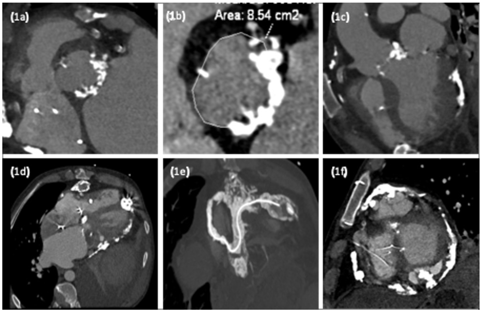 Ezad Transplanted Heart Figure 1
