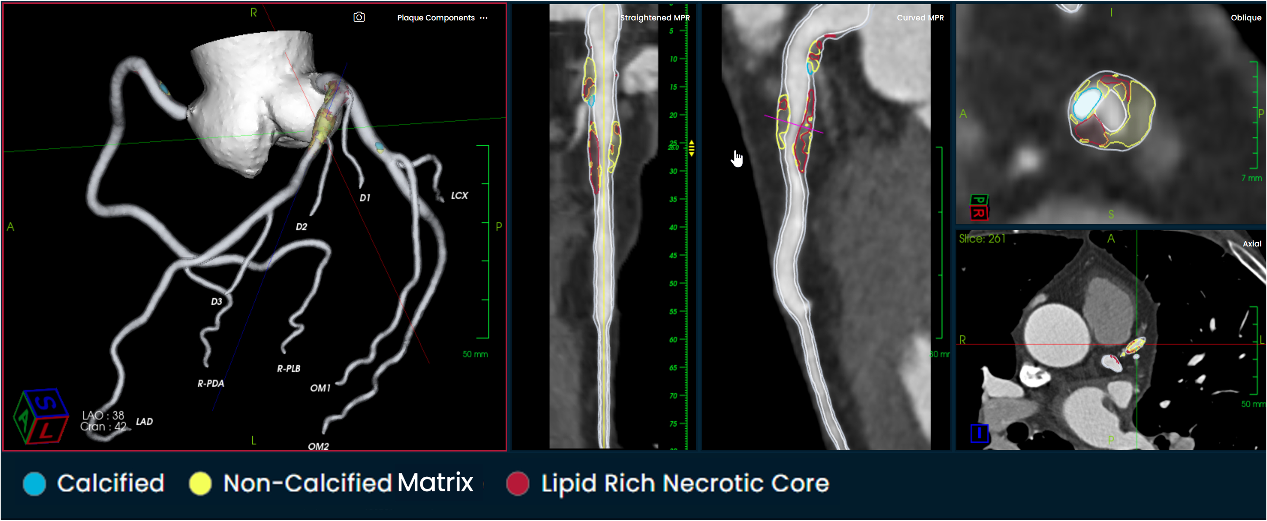 Elucid Receives U.S. 510(k) Clearance of PlaqueIQ Image Analysis ...