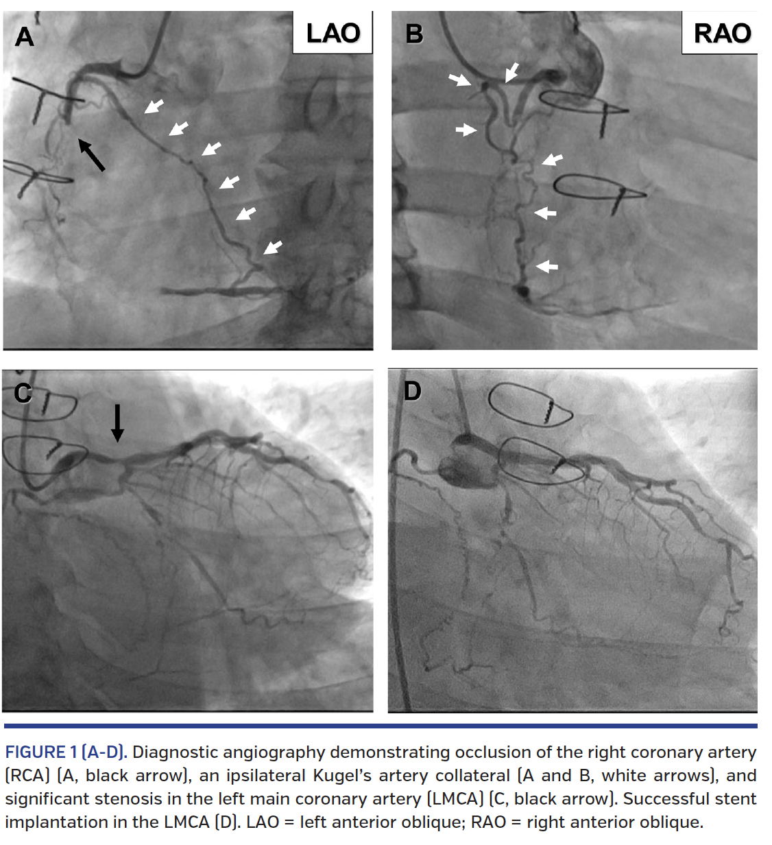 FIGURE 1 (A-D). Diagnostic angiography.png
