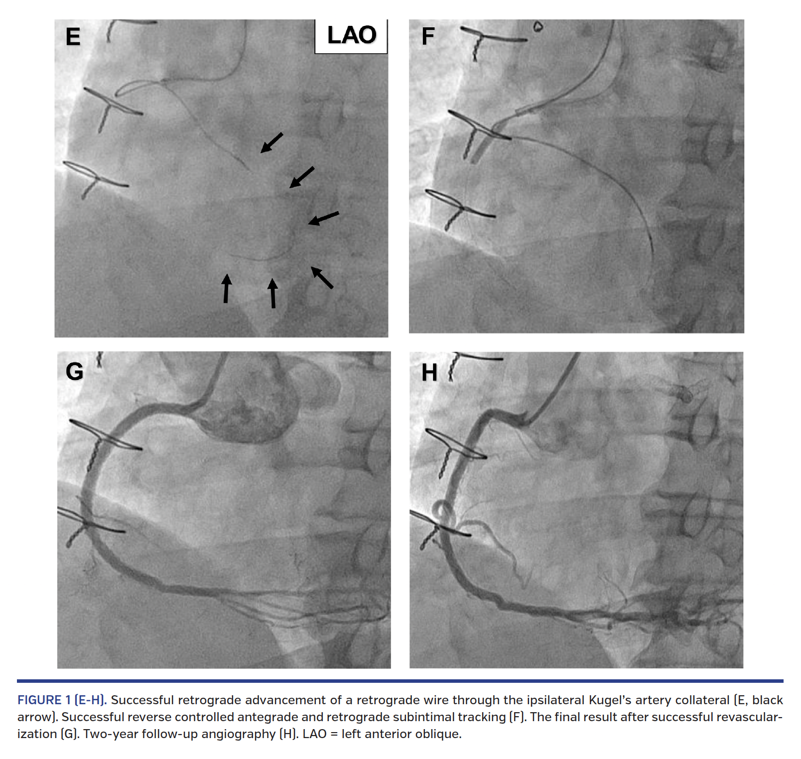 FIGURE 1 (E-H). Successful retrograde advancement.png