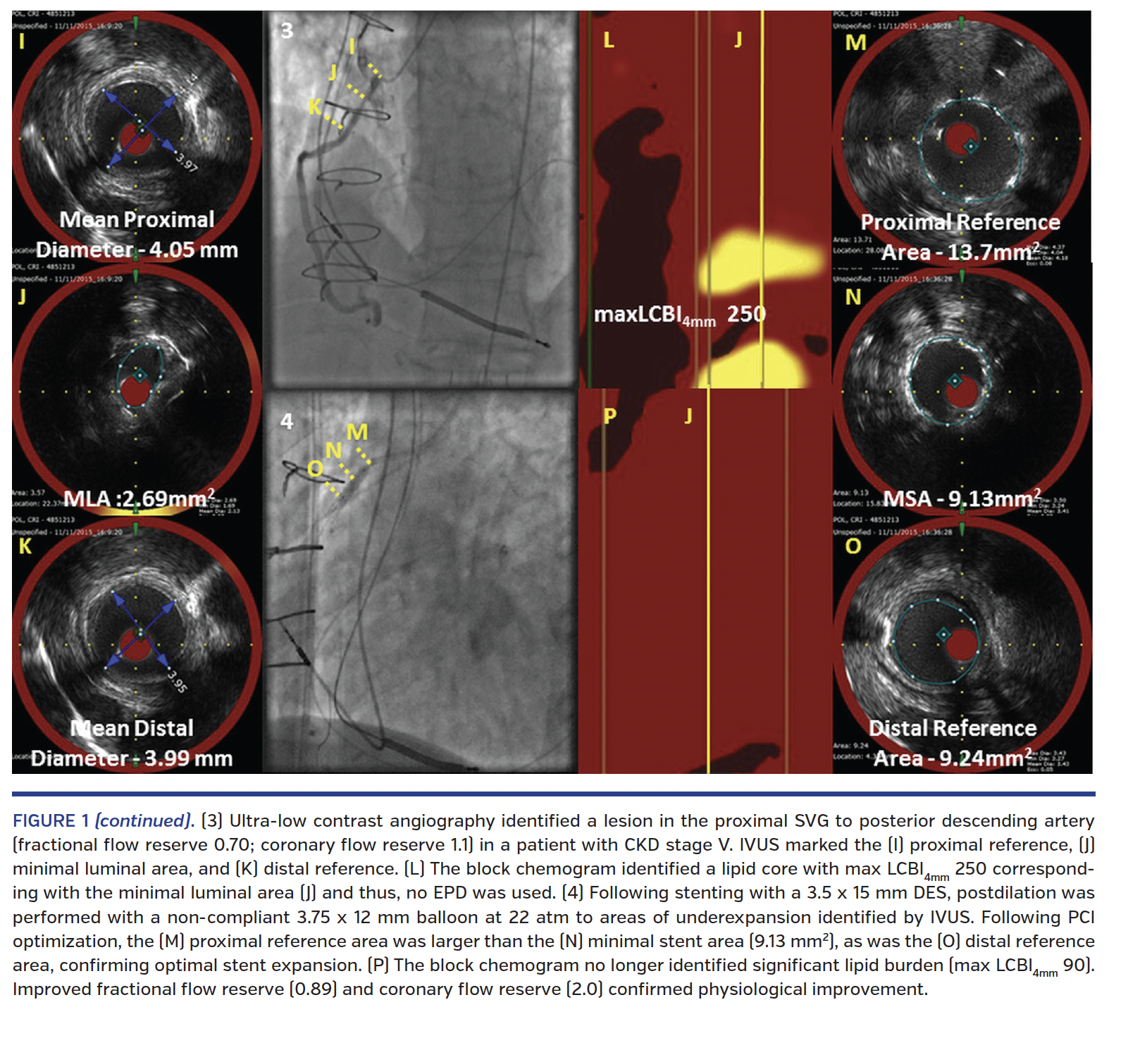 Imaging and Physiology to Guide Venous Graft Interventions Without ...