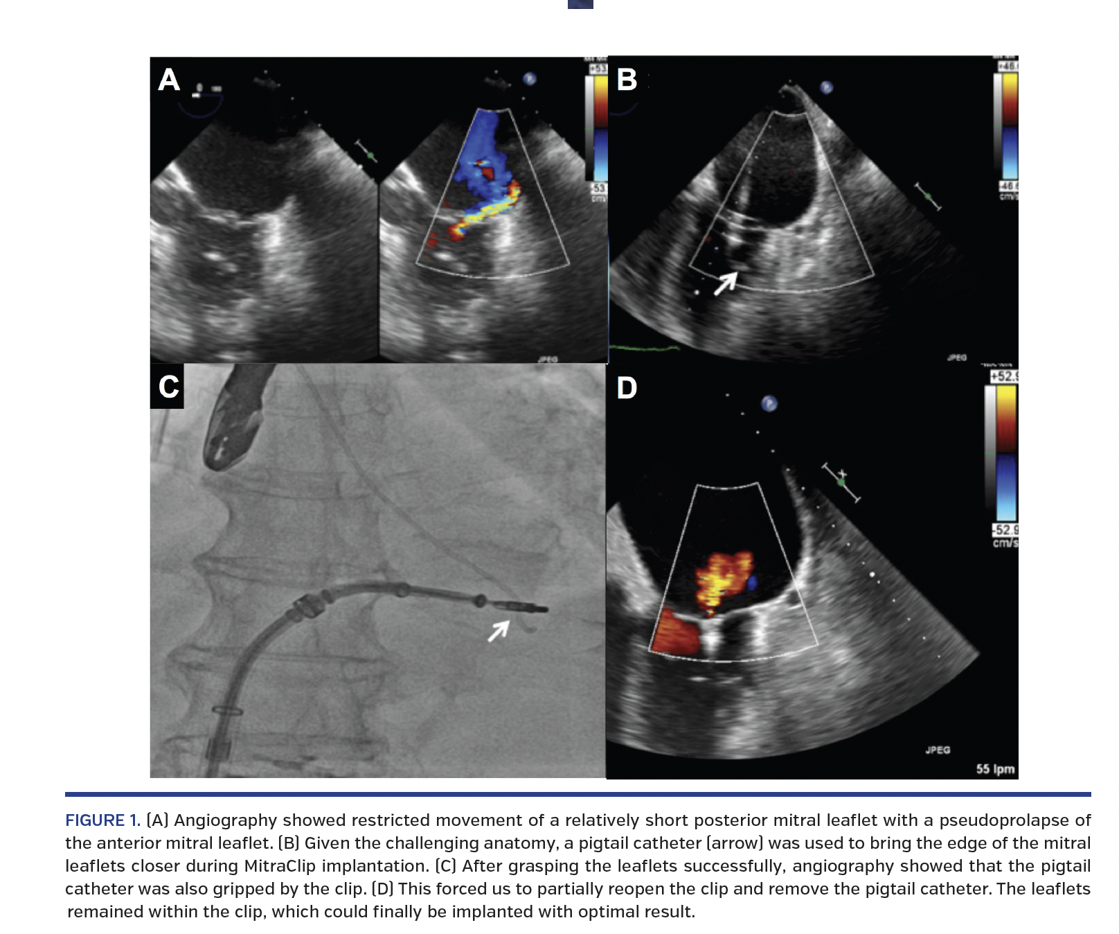 FIGURE 1. (A) Angiography.png