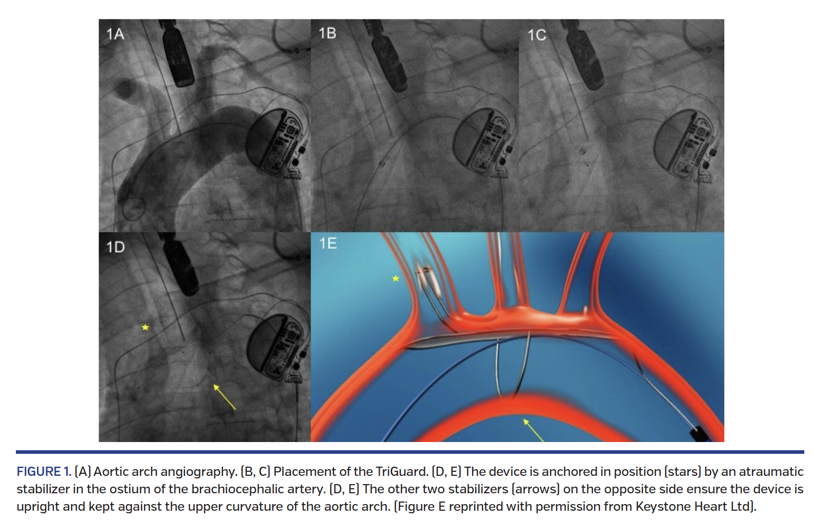 FIGURE 1. (A) Aortic arch angiography..png