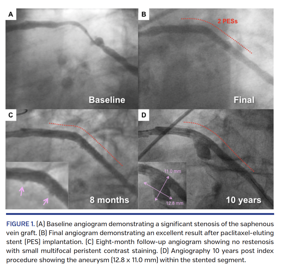 FIGURE 1. (A) Baseline angiogram demonstrating a significant stenosis