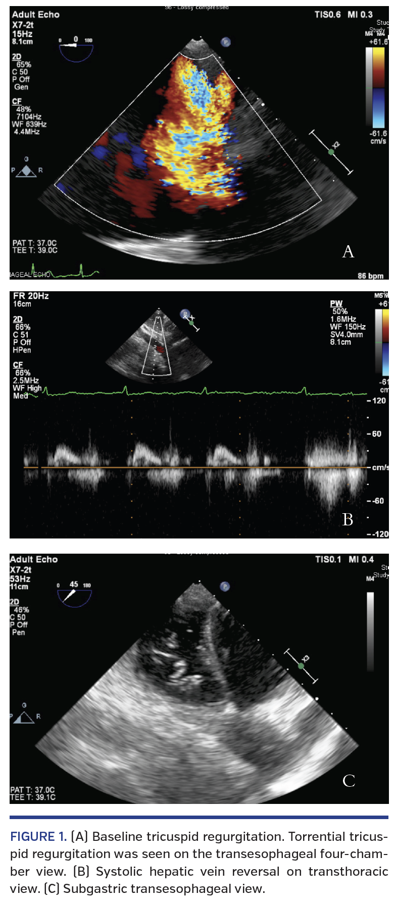 FIGURE 1. (A) Baseline tricuspid regurgitation..png