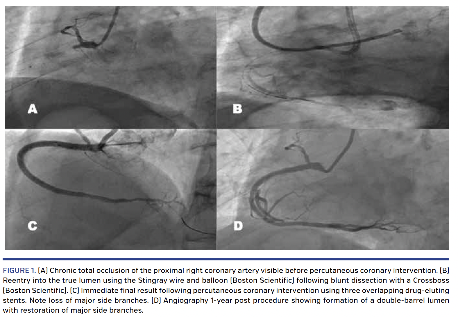 FIGURE 1. (A) Chronic total occlusion of the proximal right coronary artery visible before percutaneous coronary intervention.