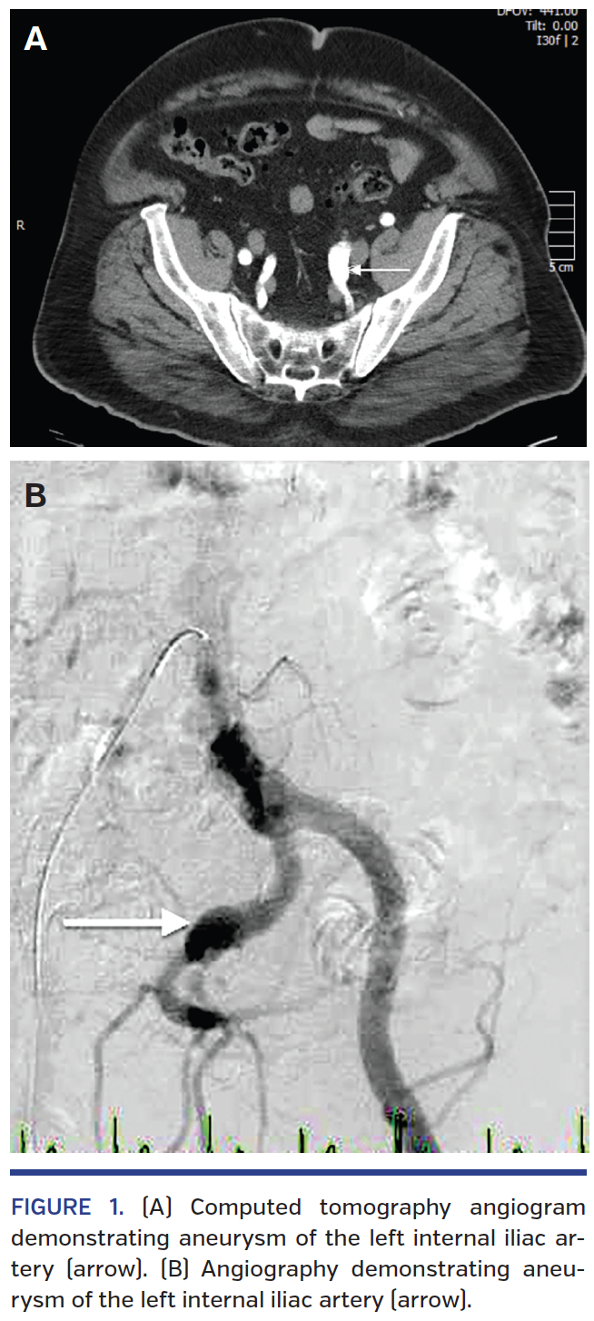 FIGURE 1. (A) Computed tomography angiogram.png