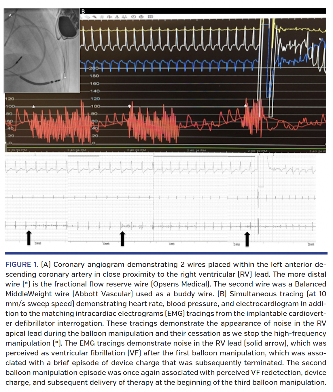 FIGURE 1. (A) Coronary angiogram