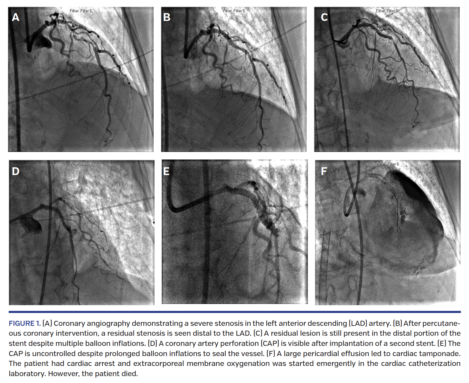 FIGURE 1. (A) Coronary angiography demonstrating a severe stenosis in the left anterior descending (LAD) artery..png