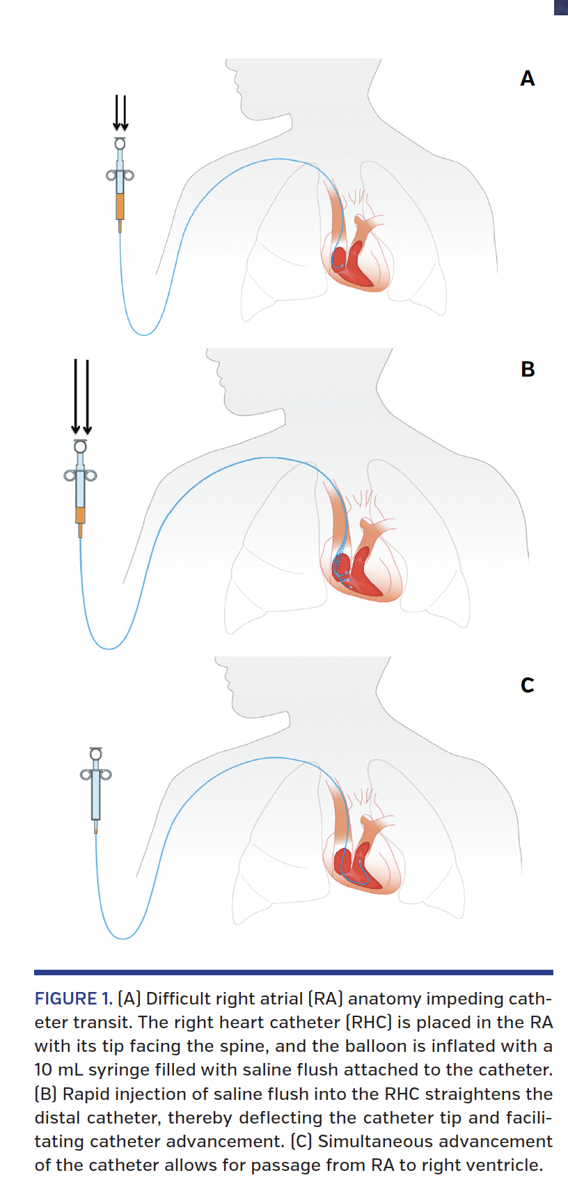 FIGURE 1. (A) Difficult right atrial.png