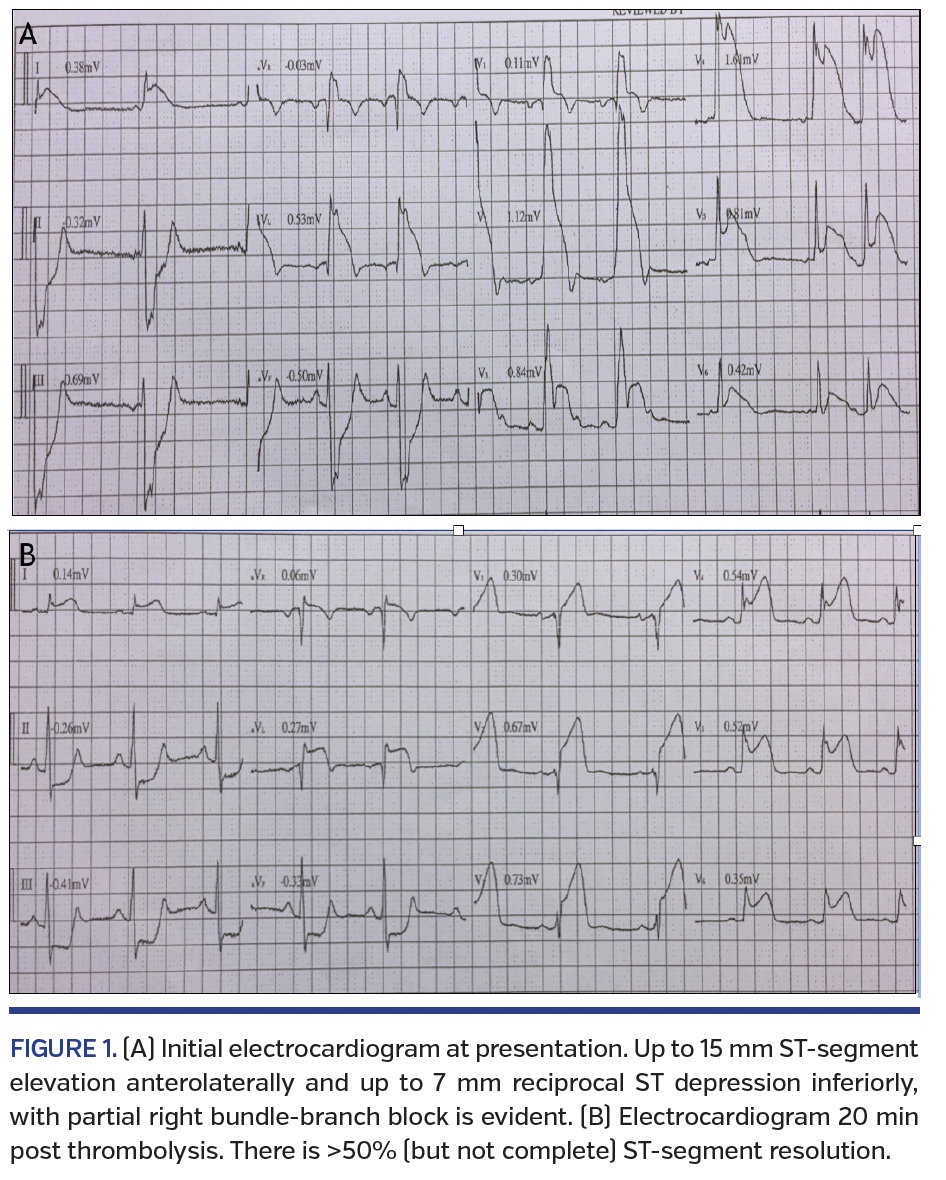 FIGURE 1. (A) Initial electrocardiogram at presentation..png
