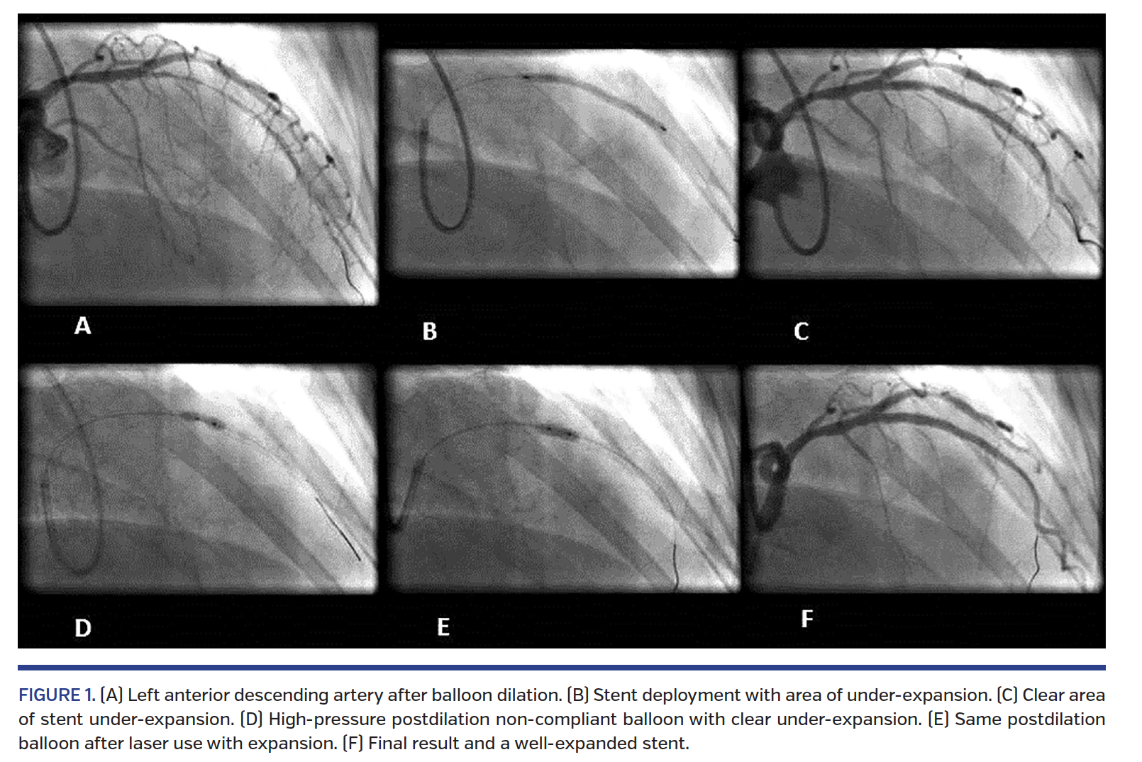 FIGURE 1. (A) Left anterior descending artery after balloon dilation..png