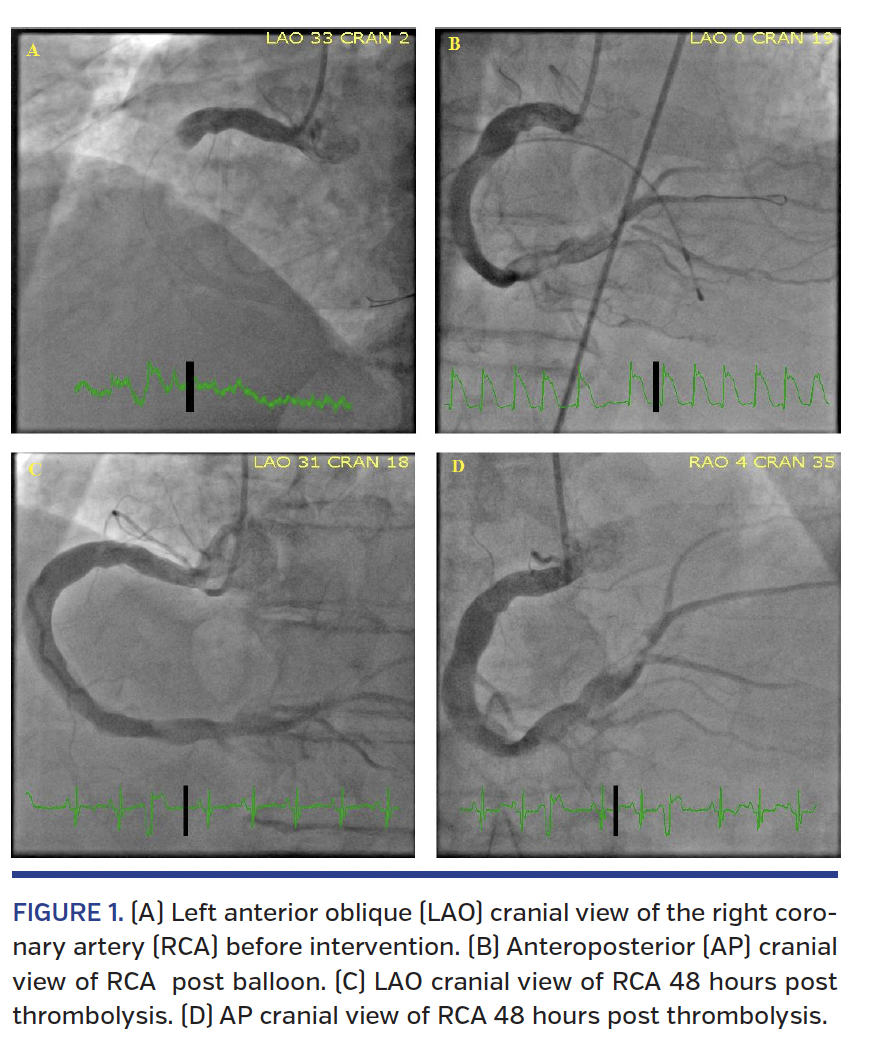 FIGURE 1. (A) Left anterior oblique.png