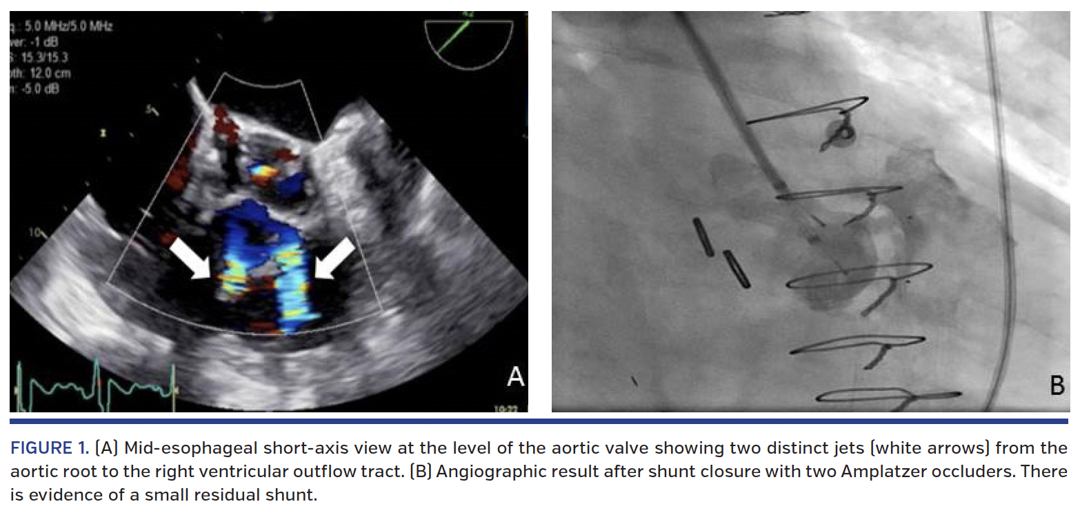 FIGURE 1. (A) Mid-esophageal short-axis view