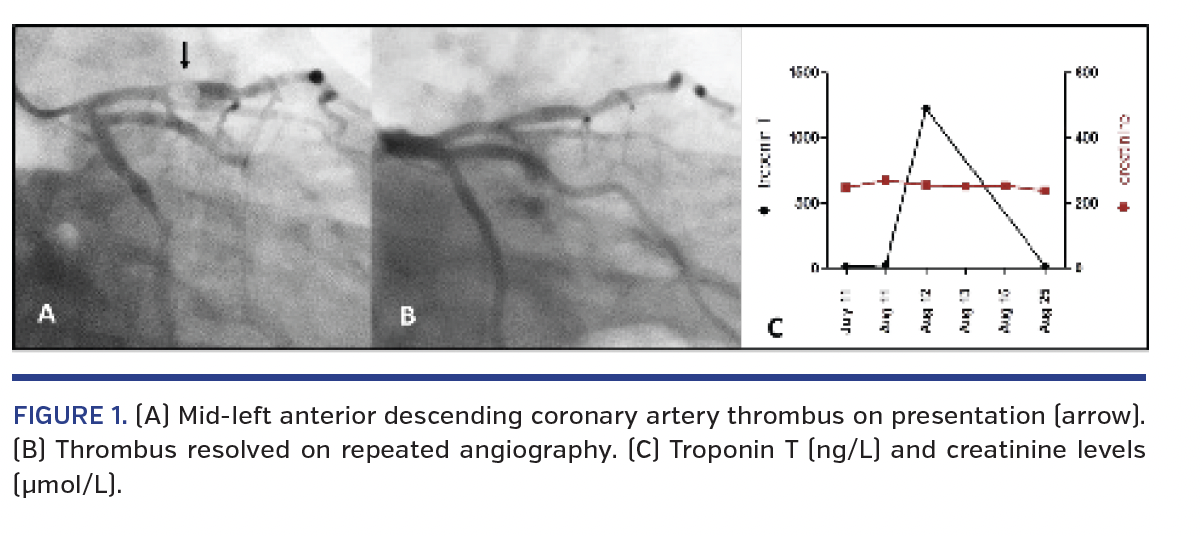 FIGURE 1. (A) Mid-left anterior descending coronary artery thrombus