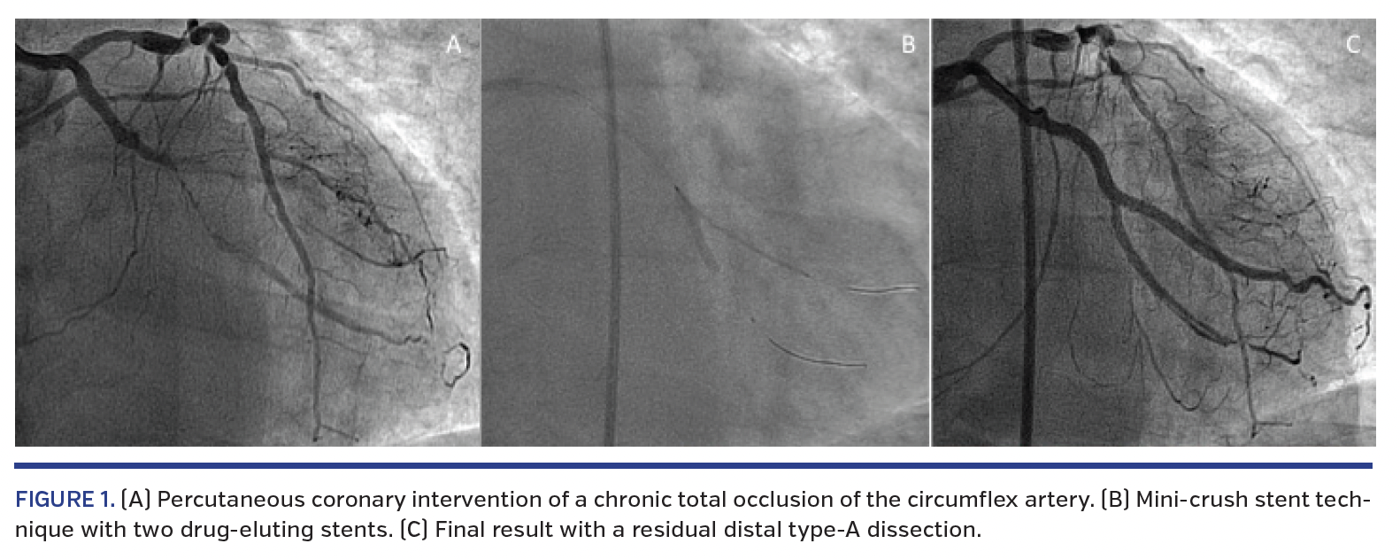 FIGURE 1. (A) Percutaneous coronary intervention.png