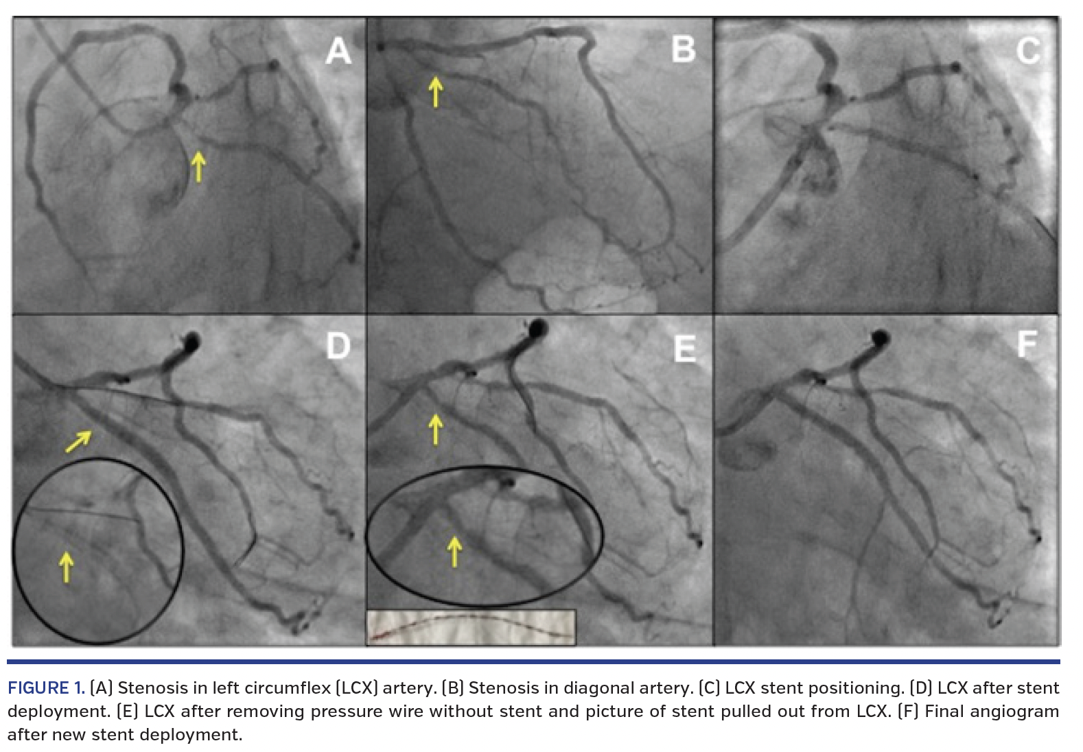 FIGURE 1. (A) Stenosis in left circumflex.png