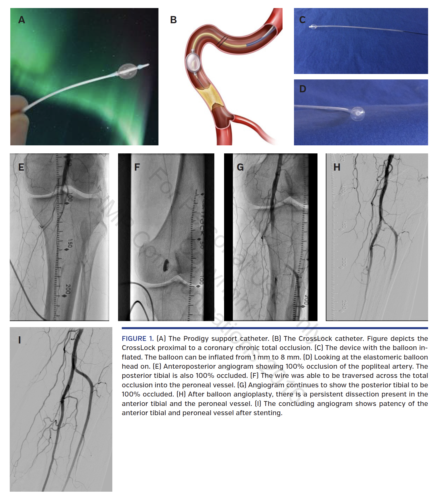 FIGURE 1. (A) The Prodigy support catheter..png