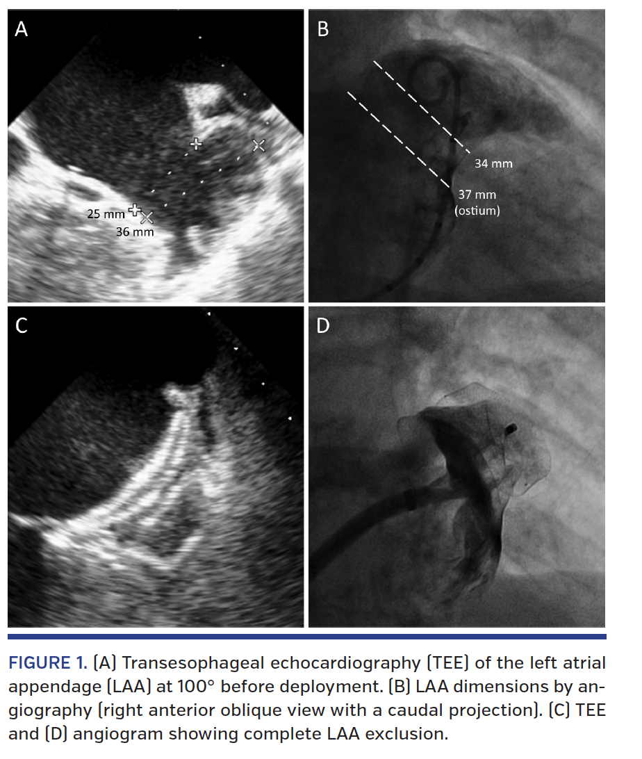 FIGURE 1. (A) Transesophageal echocardiography.png