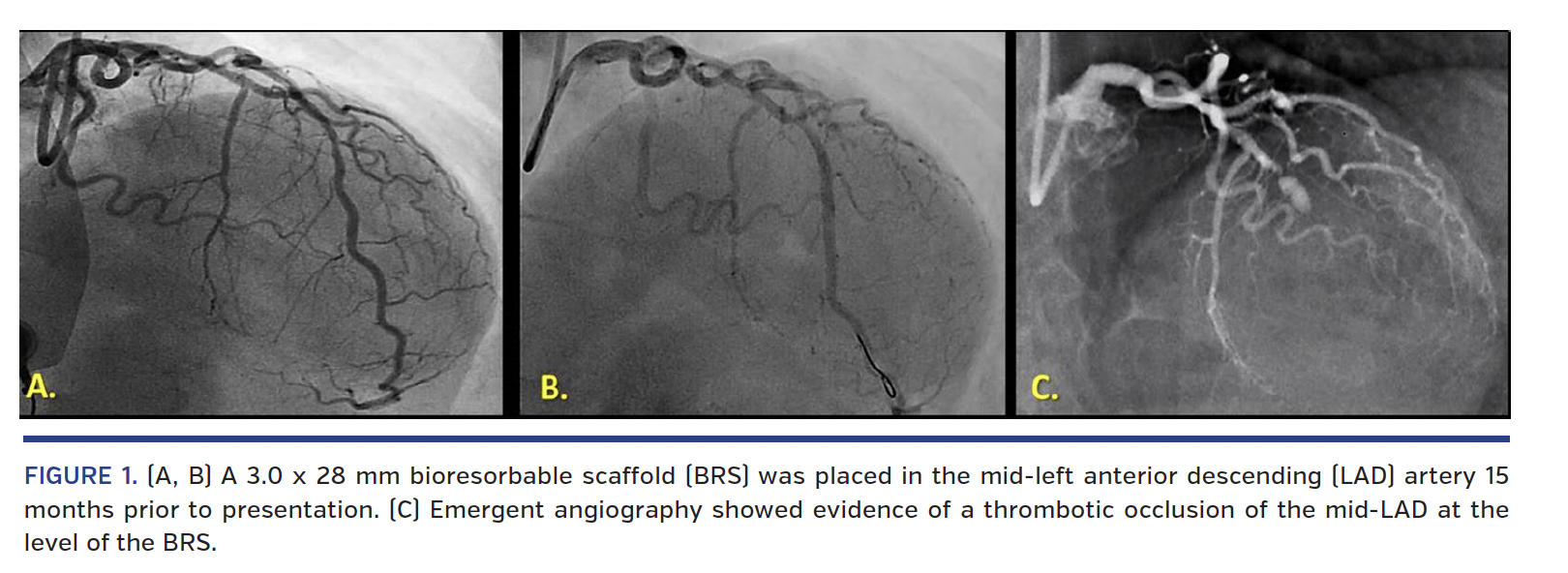 FIGURE 1. (A, B) A 3.0 x 28 mm bioresorbable scaffold.png