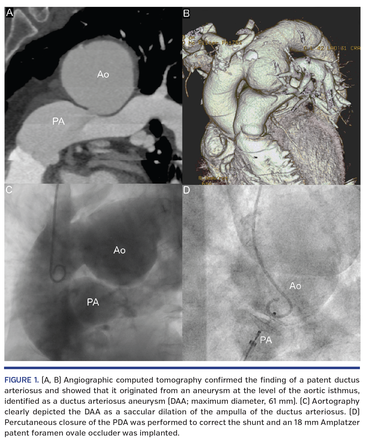 FIGURE 1. (A, B) Angiographic computed tomography