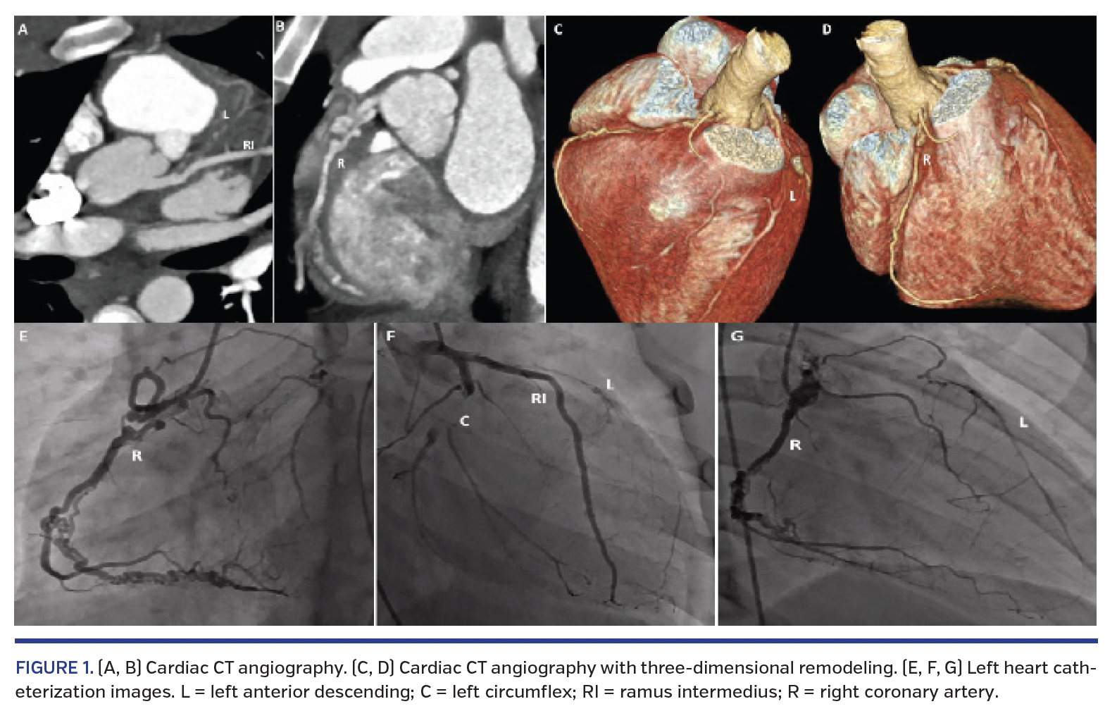 FIGURE 1. (A, B) Cardiac CT angiography..png