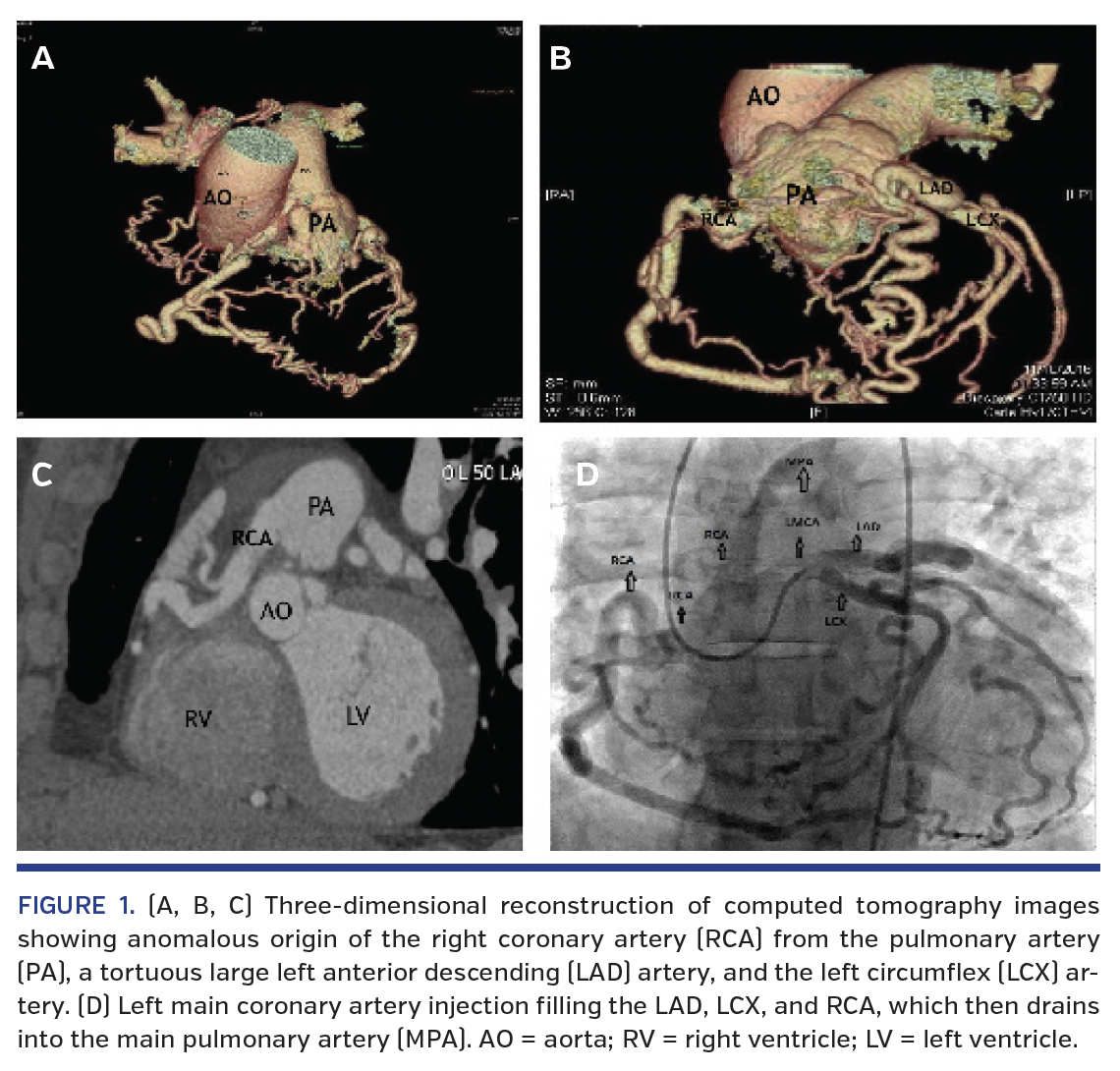 FIGURE 1. (A, B, C) Three-dimensional reconstruction of computed tomography images