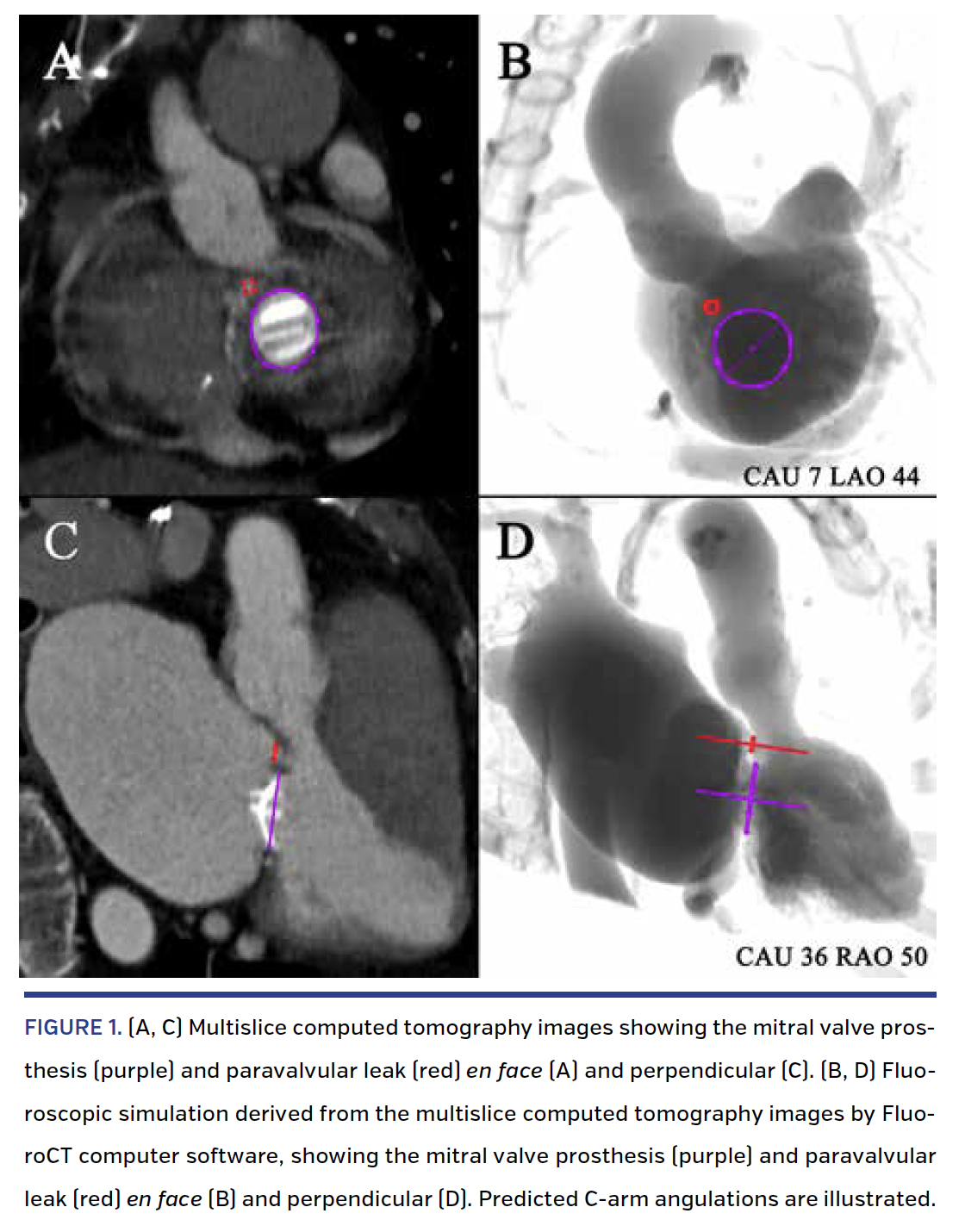 FIGURE 1. (A, C) Multislice computed tomography images.png