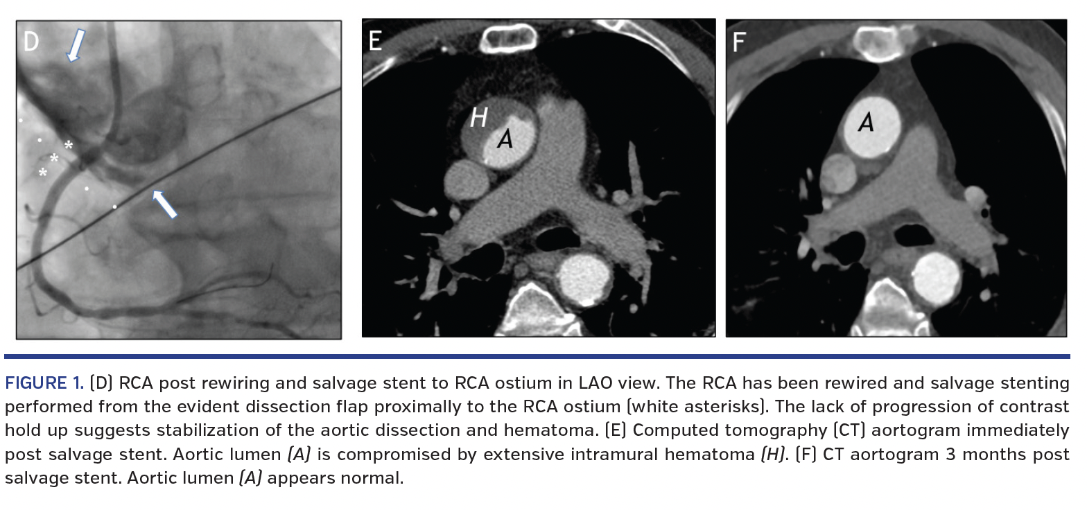 FIGURE 1. Right coronary artery.png