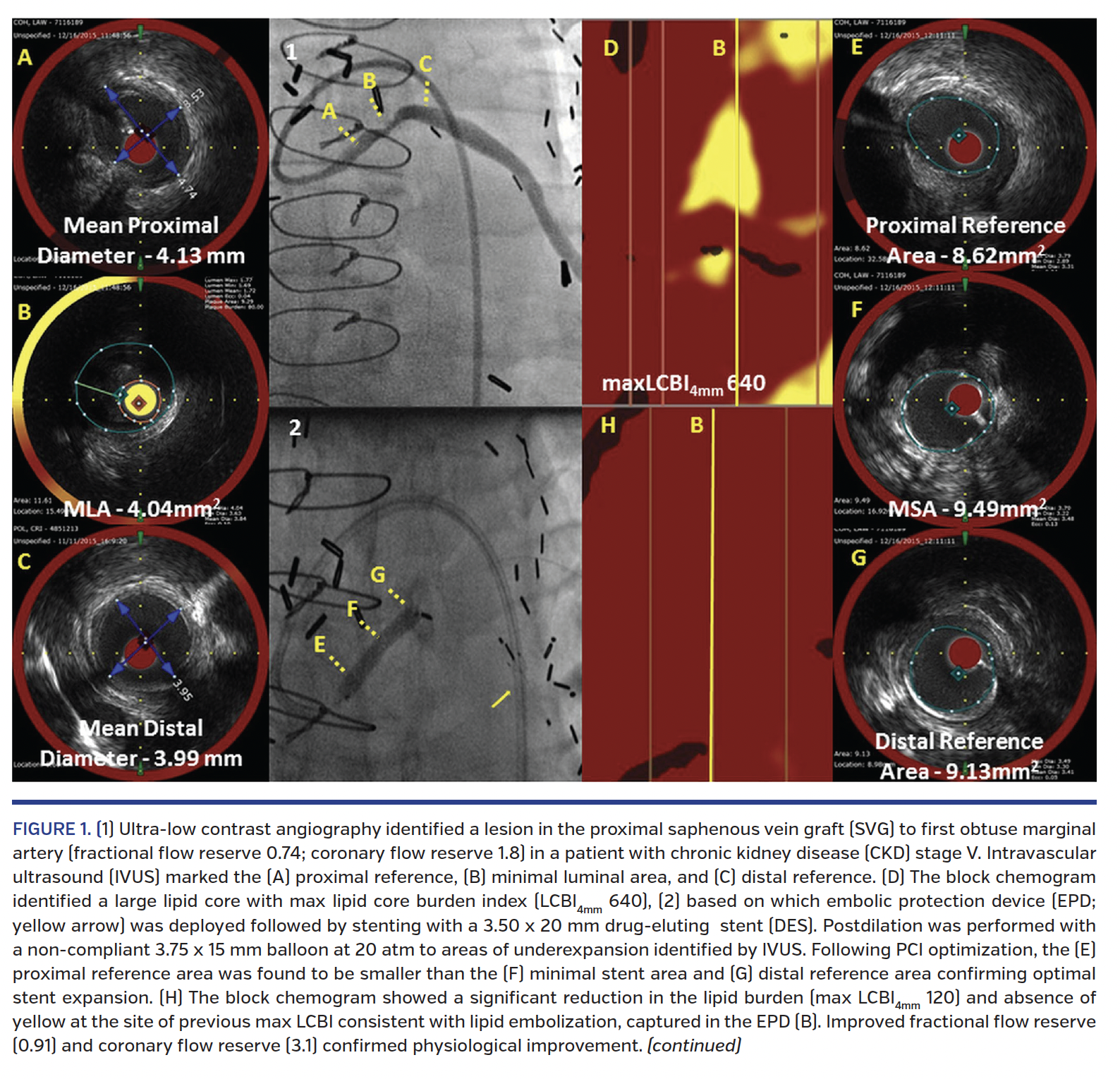 Imaging and Physiology to Guide Venous Graft Interventions Without ...