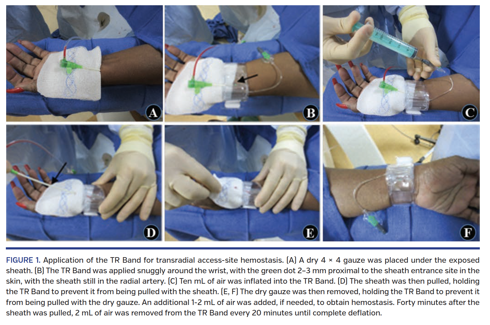 FIGURE 1. Application of the TR Band.png