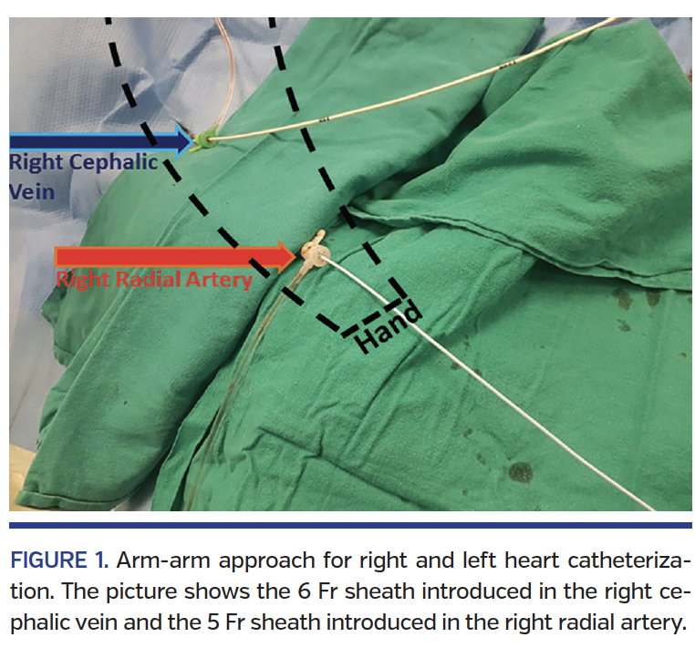 FIGURE 1. Arm-arm approach.png