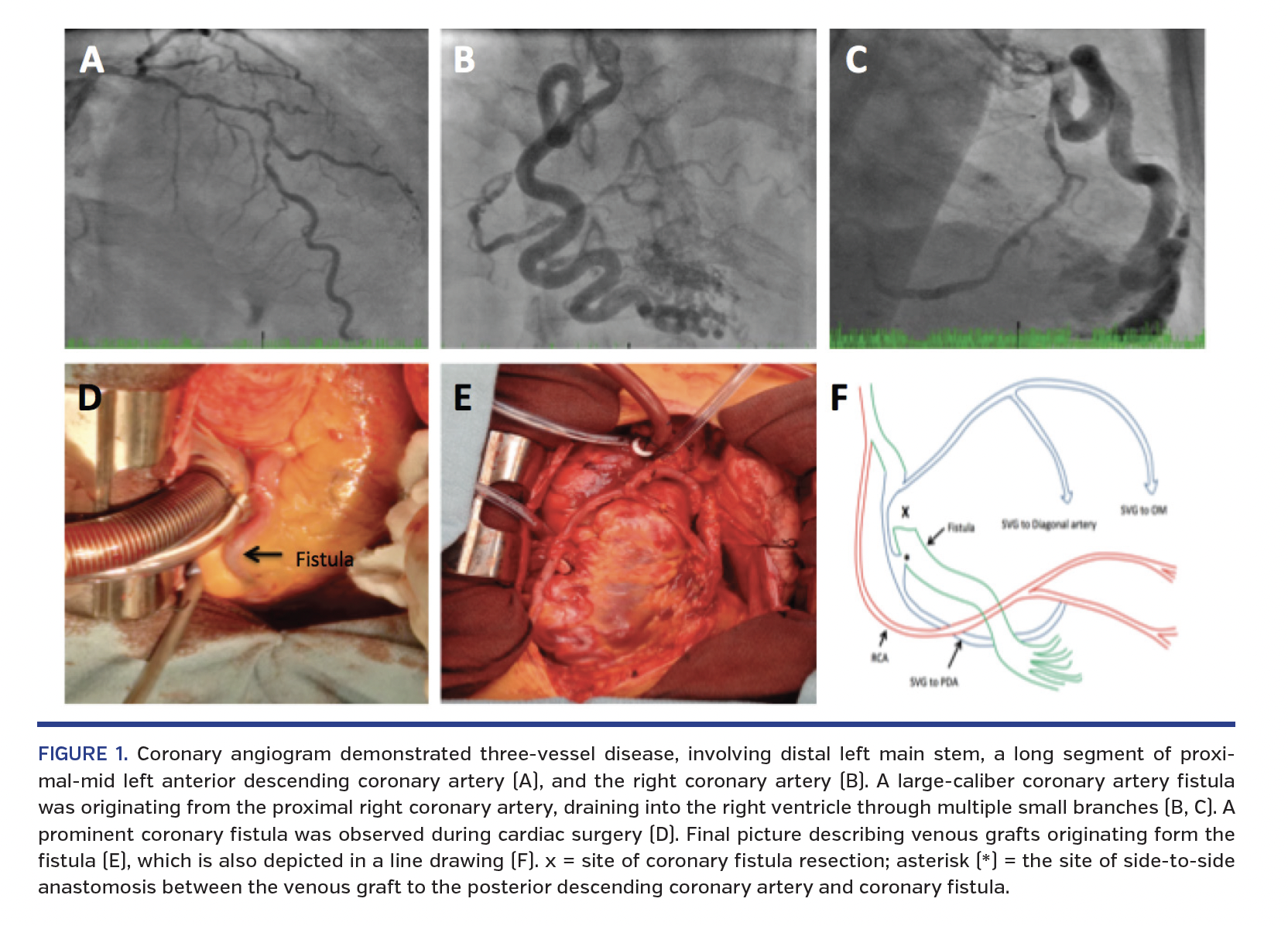 FIGURE 1. Coronary angiogram.png