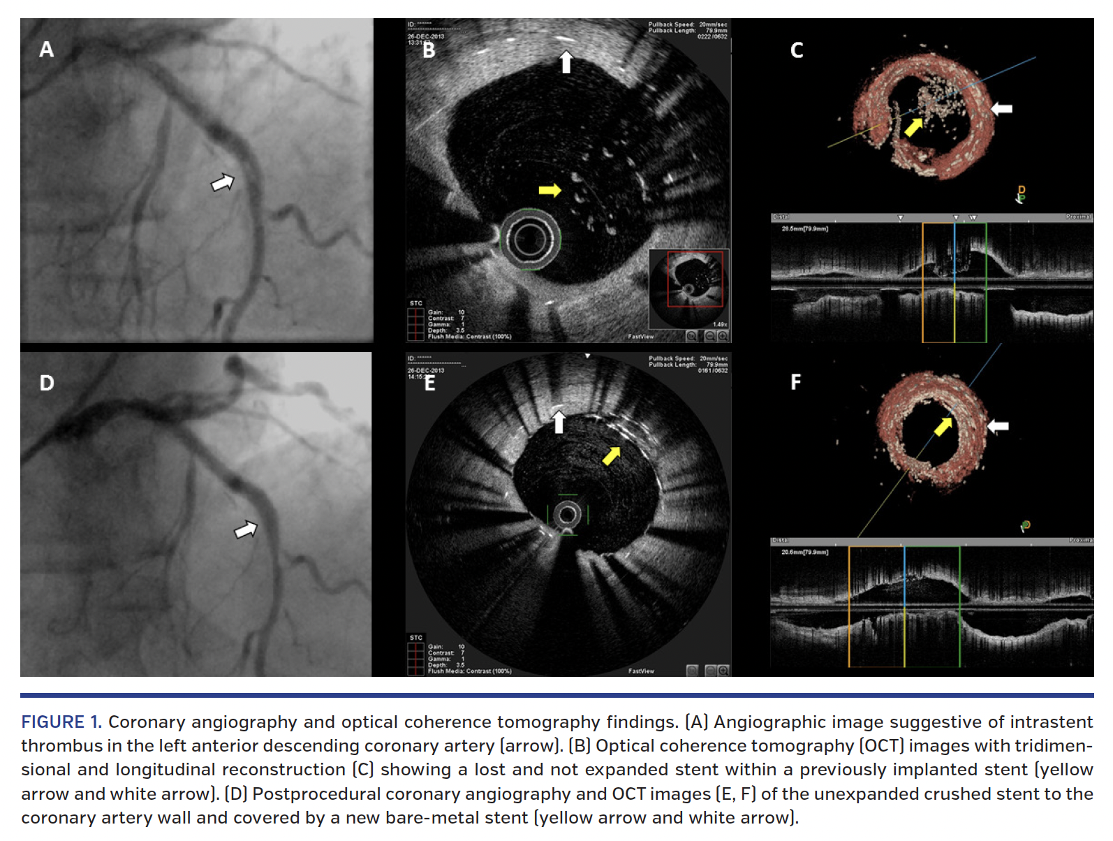 FIGURE 1. Coronary angiography and optical coherence tomography findings..png