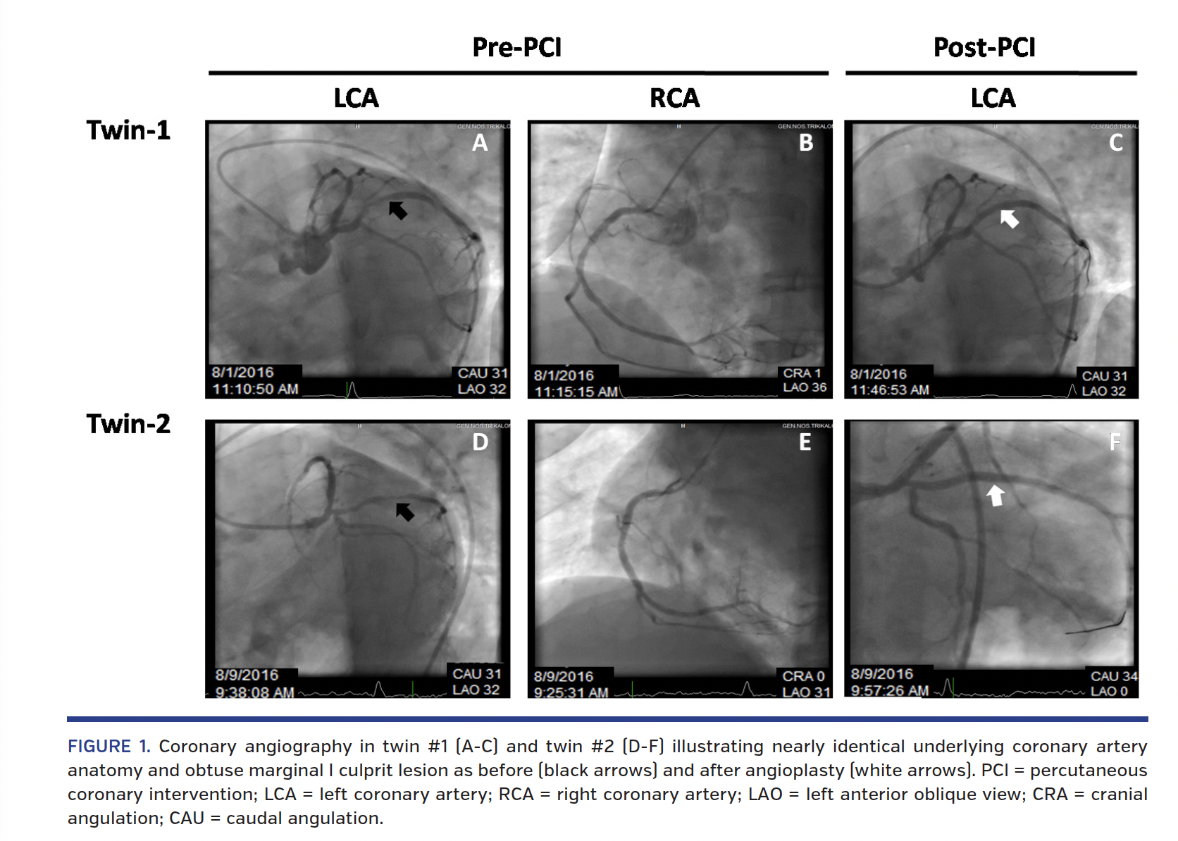 FIGURE 1. Coronary angiography