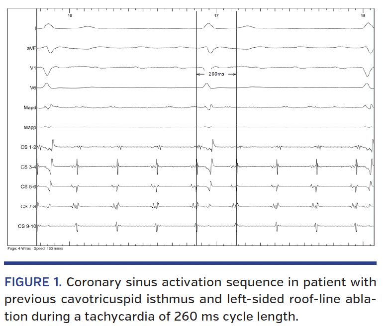 FIGURE 1. Coronary sinus activation sequence.png