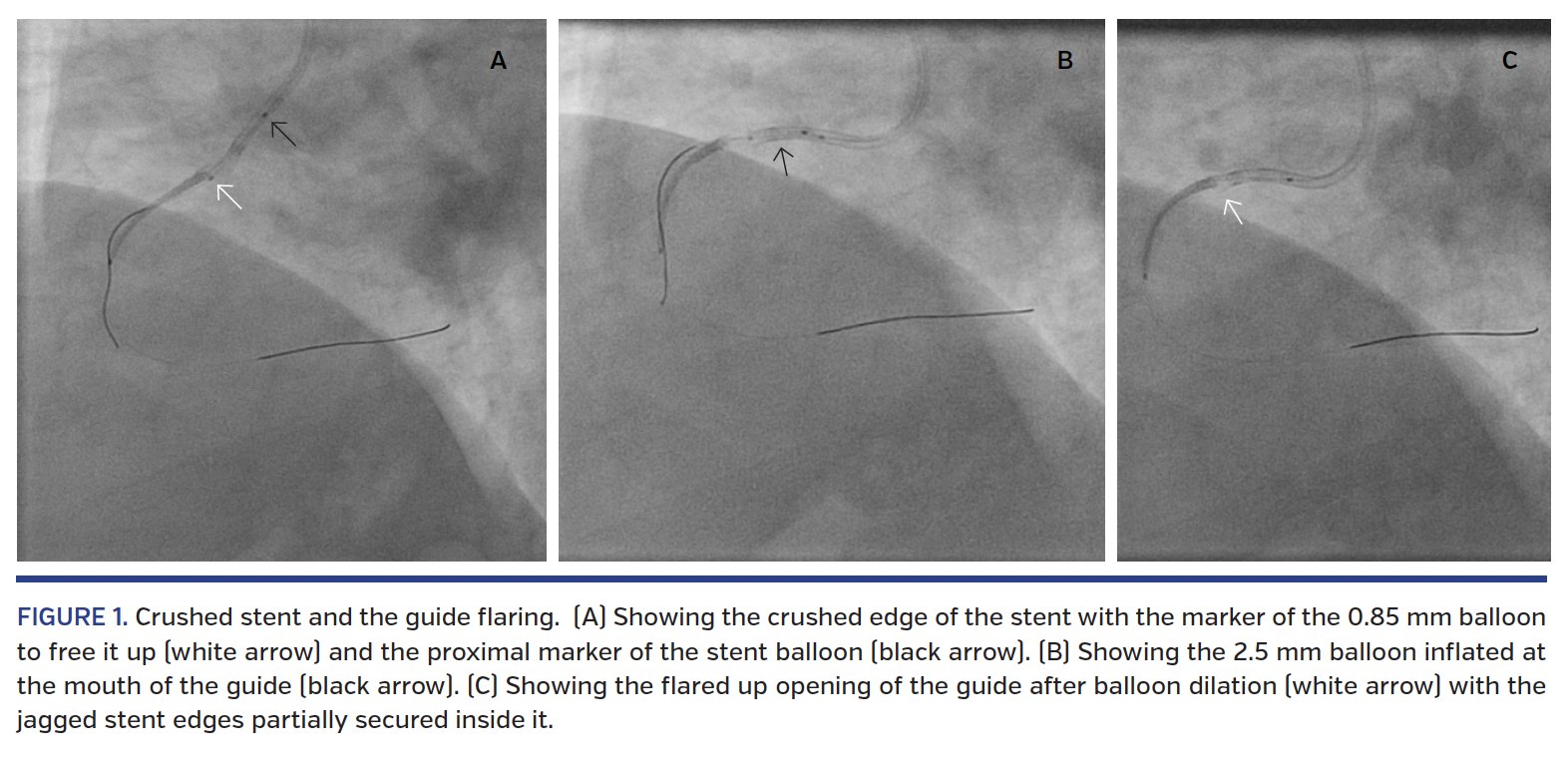 FIGURE 1. Crushed stent and the guide flaring..png