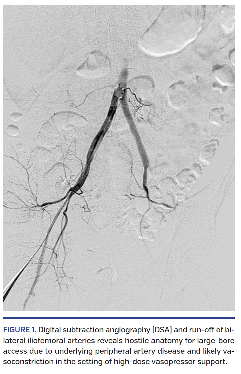 FIGURE 1. Digital subtraction angiography.png