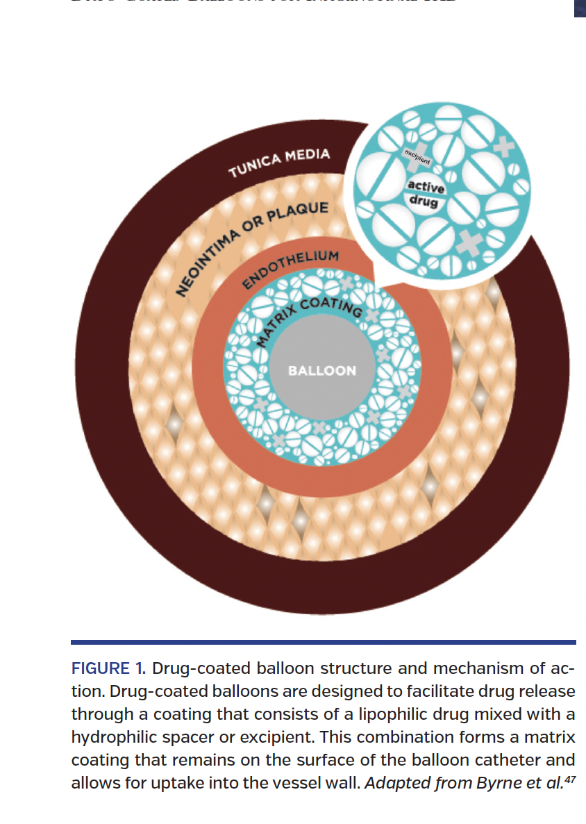 FIGURE 1. Drug-coated balloon structure.png