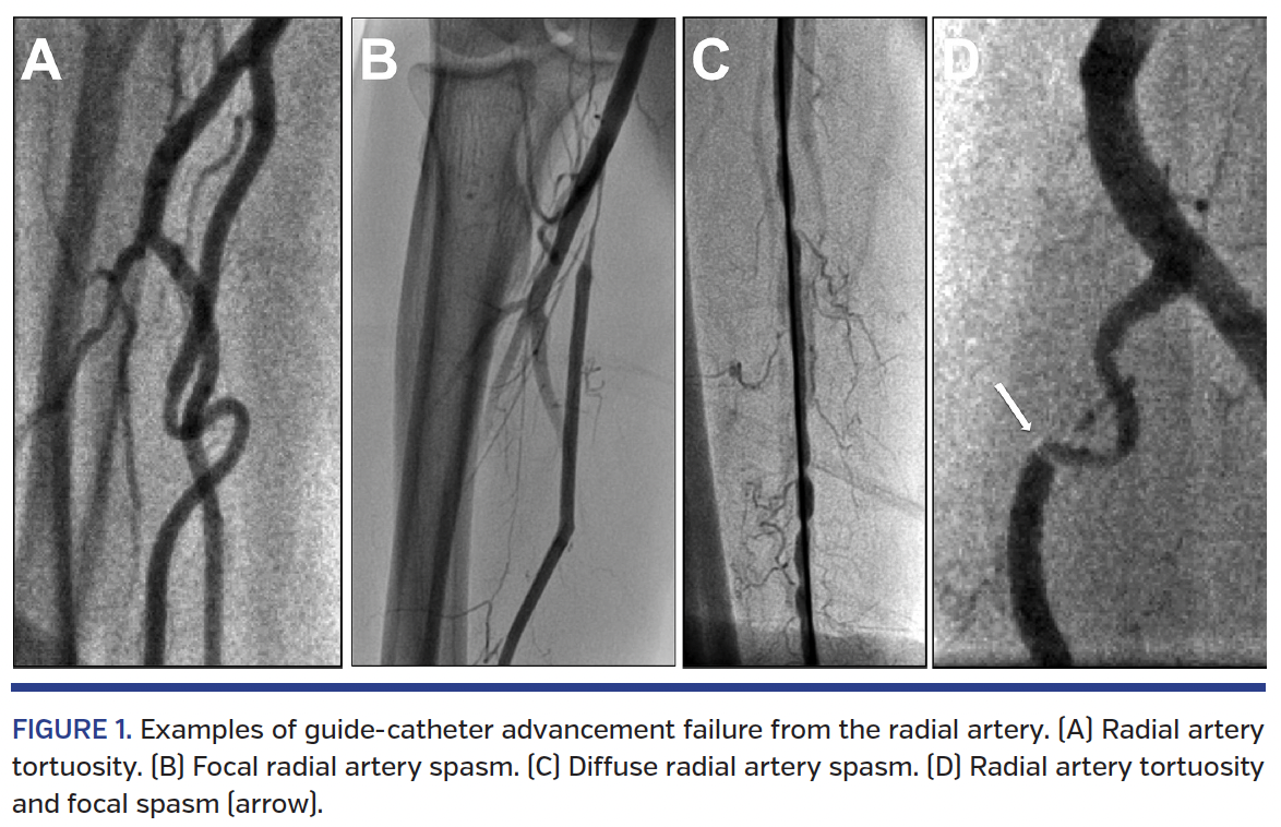 FIGURE 1. Examples of guide-catheter advancement failure.png