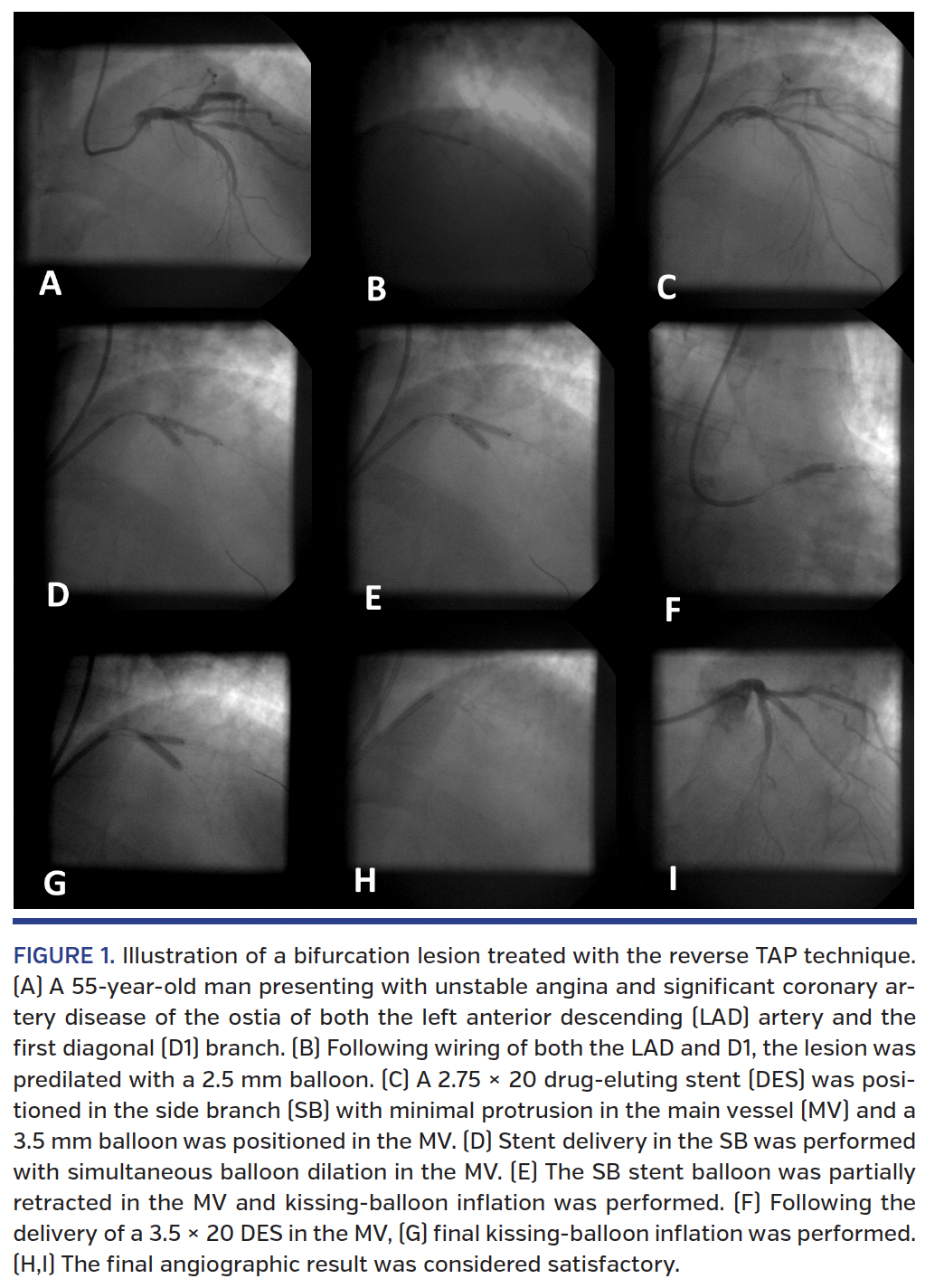 FIGURE 1. Illustration of a bifurcation lesion treated with the reverse TAP technique..png