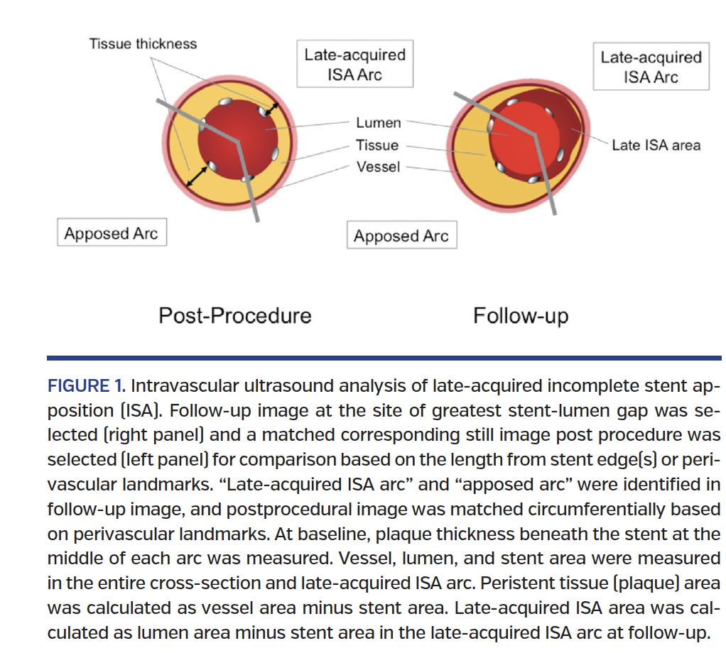 FIGURE 1. Intravascular ultrasound analysis of late-acquired incomplete stent apposition.png