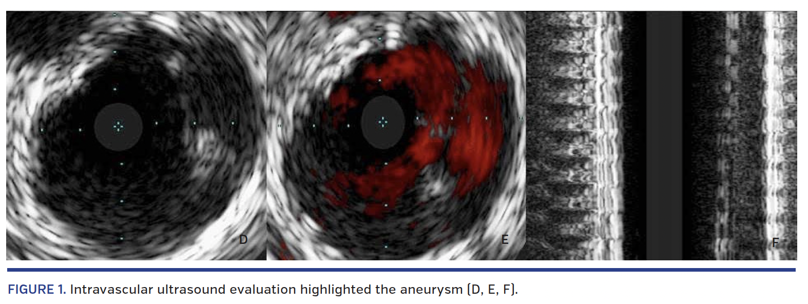 FIGURE 1. Intravascular ultrasound.png