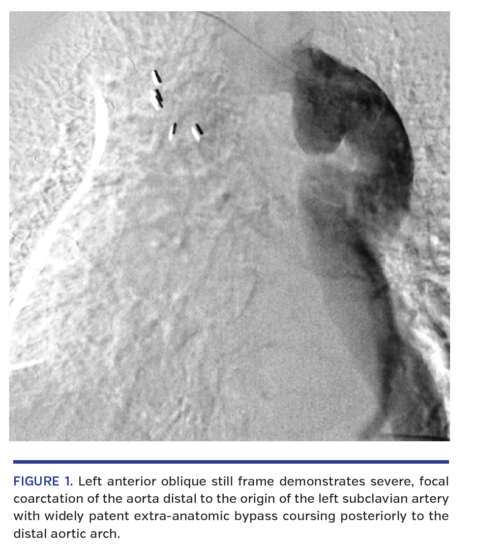 FIGURE 1. Left anterior oblique.png