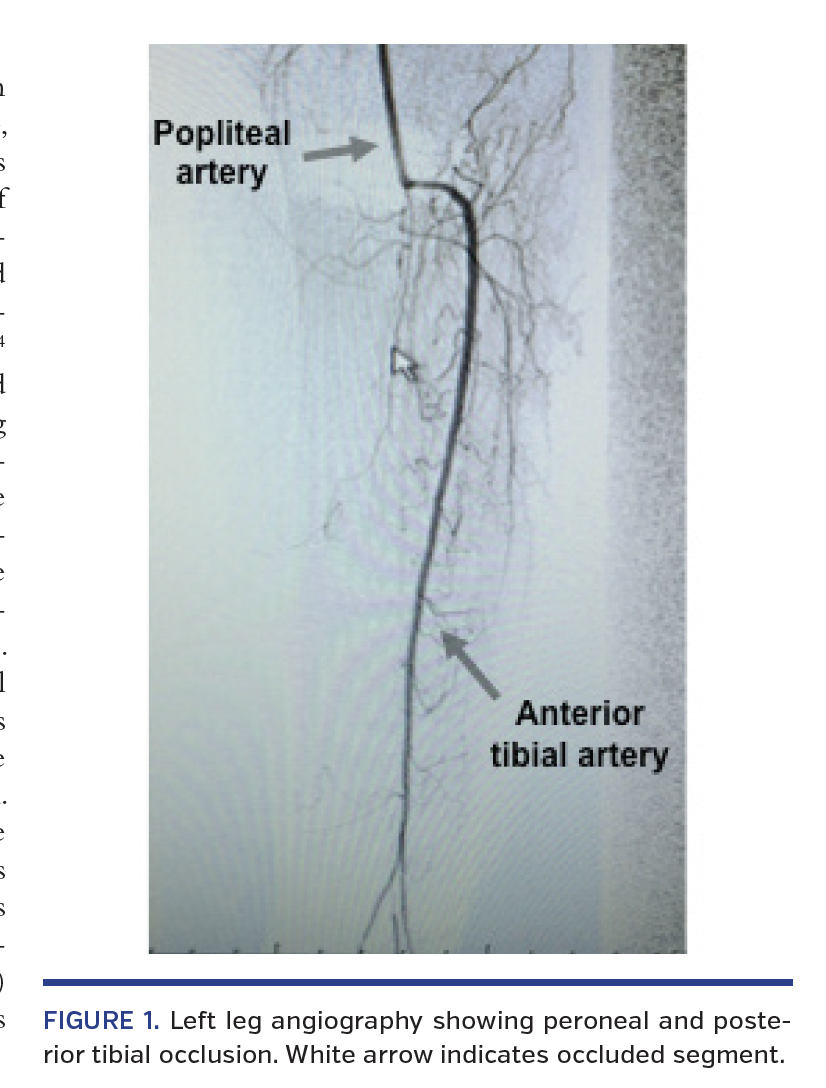 FIGURE 1. Left leg angiography.png